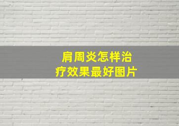 肩周炎怎样治疗效果最好图片